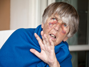 elderly woman with bruises